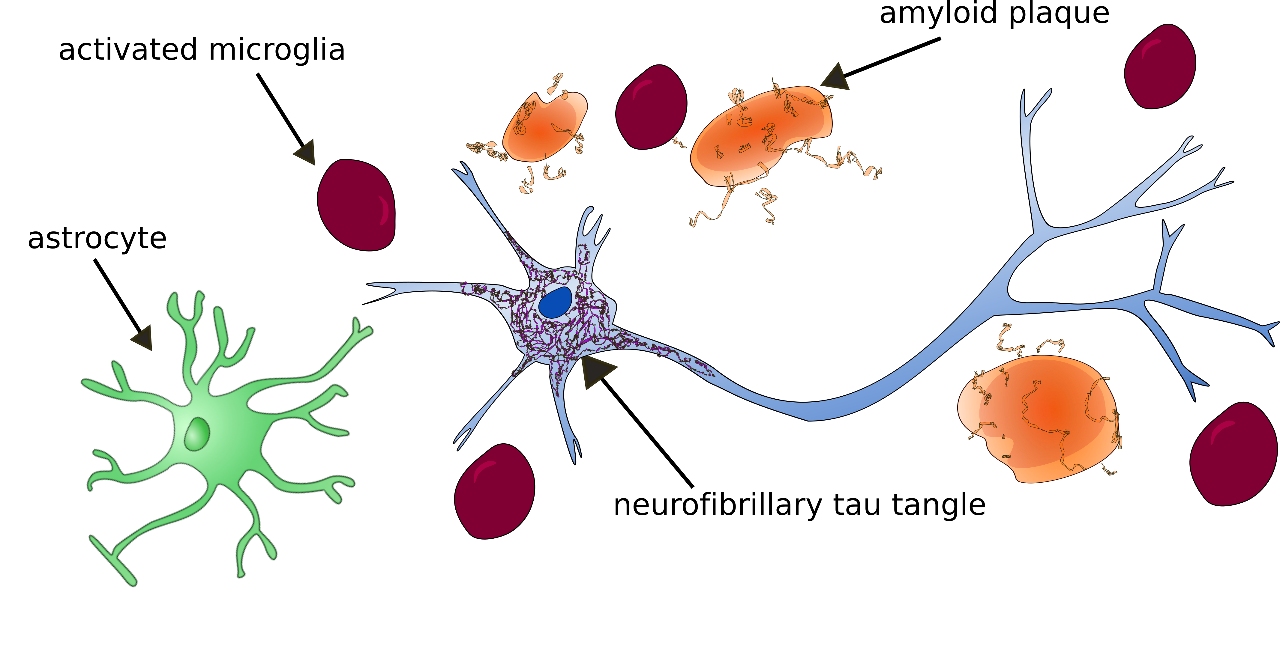 A basic cartoon schematic to show the pathology of Alzheimer's disease. Specifically, the inflammatory glial response includes activated microglia and astrocytes. The neurofibrillary tau tangles are interneuronal, and the amyloid plaques, surrounded by diffuse halos of amyloid-Beta, are extracellular.